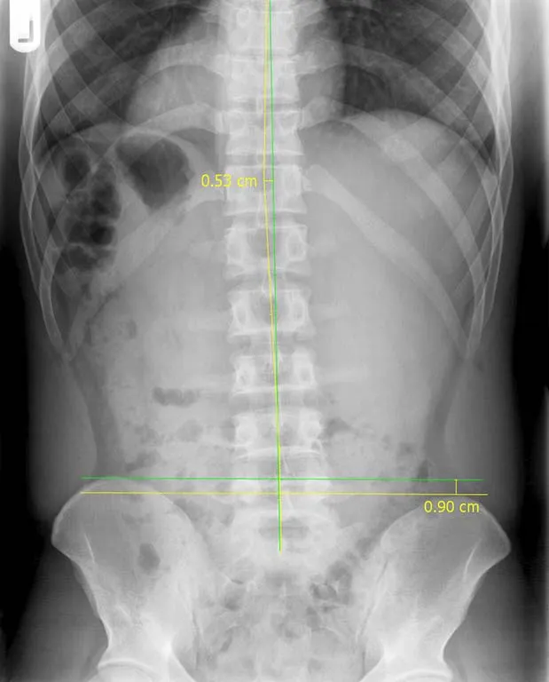 precision-chiropractic-Spine-Lumbar-xray-after precision chiropractic Spine Lumbar xray after