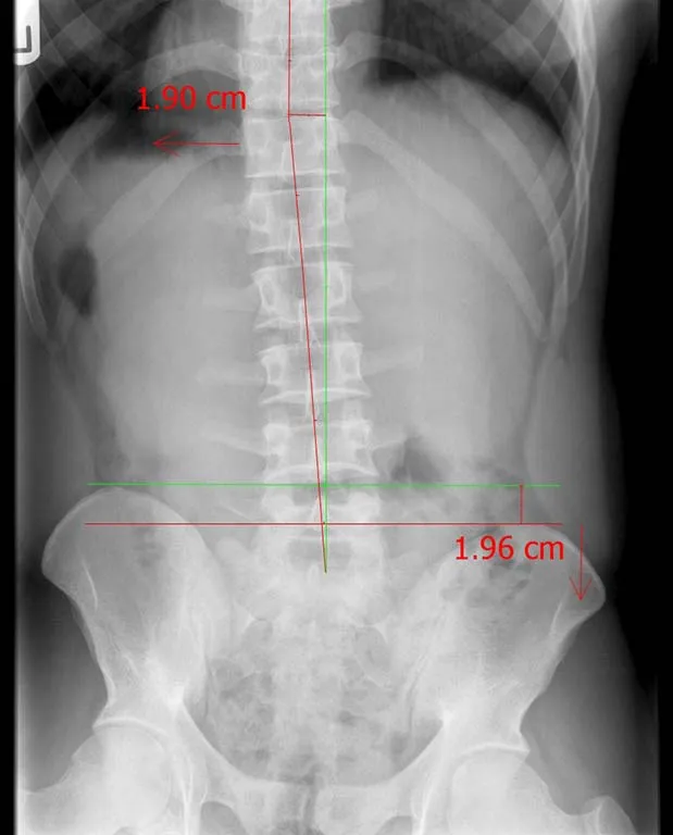precision-chiropractic-Spine-Lumbar-xray-before precision chiropractic Spine Lumbar xray before